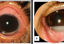 Case of Masquerade Uveitis with Hypopyon Case of Masquerade Uveitis with Hypopyon
