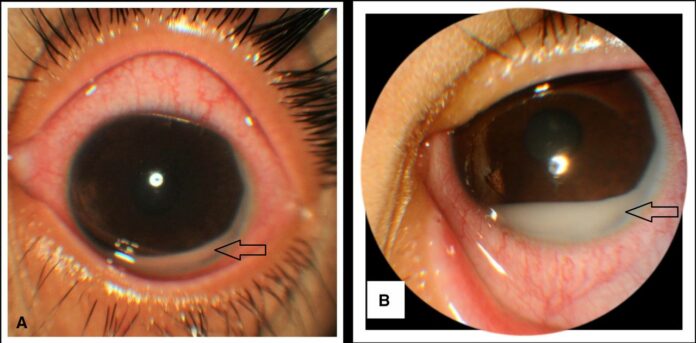 Case of Masquerade Uveitis with Hypopyon