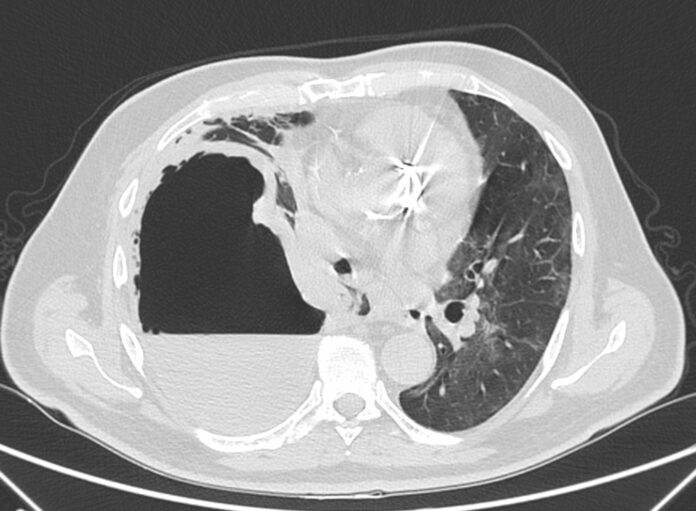 Pneumothorax