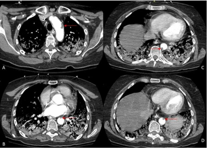 Aortic thrombosis