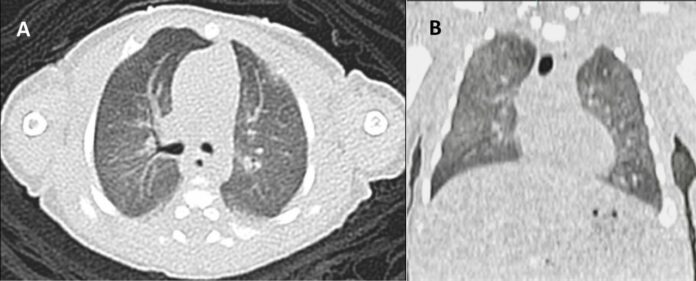 Respiratory distress syndrome