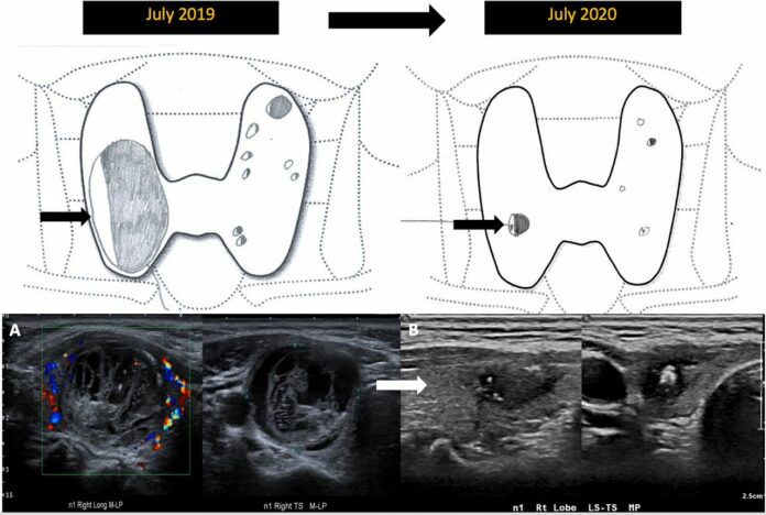 Mummification of benign thyroid nodule