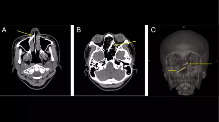 Chopsticks lodged in nasal cavity