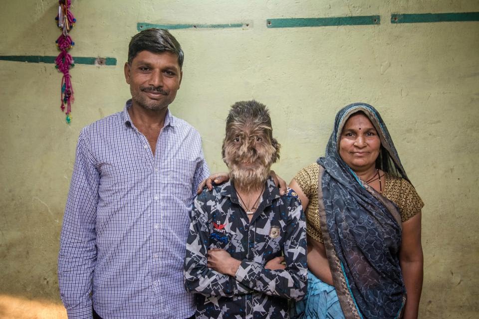 hypertrichosis family