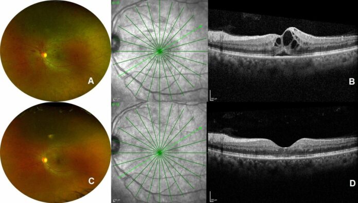 Central retinal vein occlusion