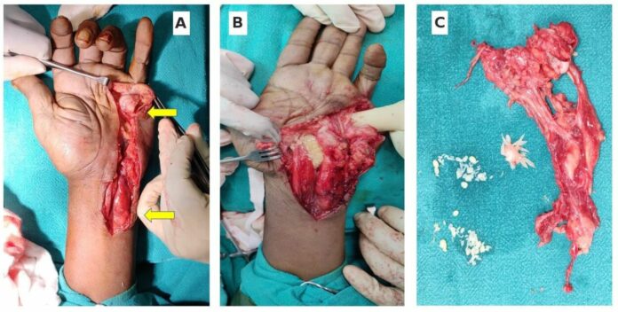 Tuberculous flexor tenosynovitis