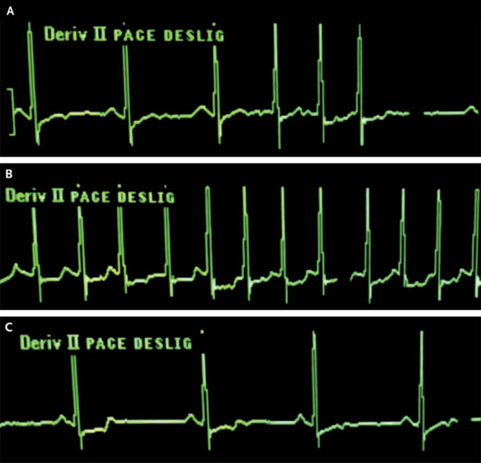 Speech-Induced Atrial Tachycardia