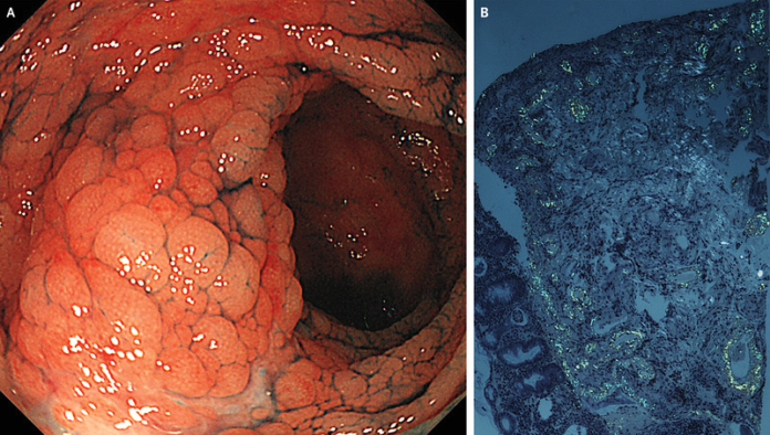 Gastrointestinal Amyloidosis