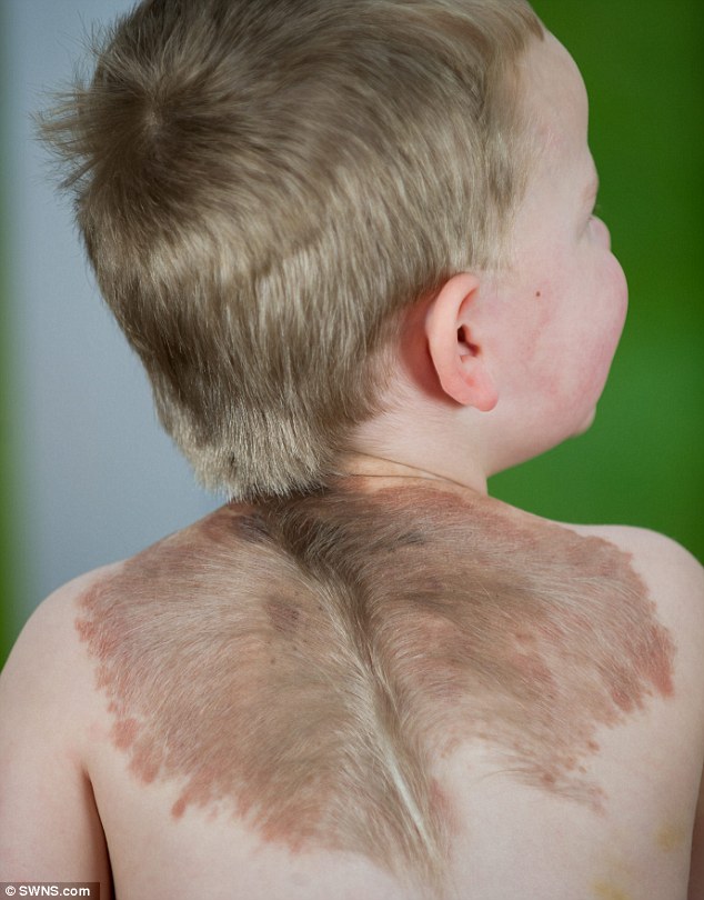 Boy With a Skin Condition Resembling A Pair of Wings - MEDizzy Journal