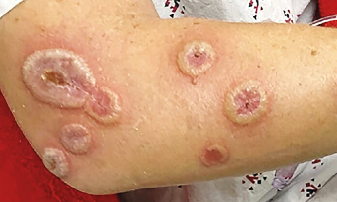 Acute Febrile Neutrophilic Dermatosis