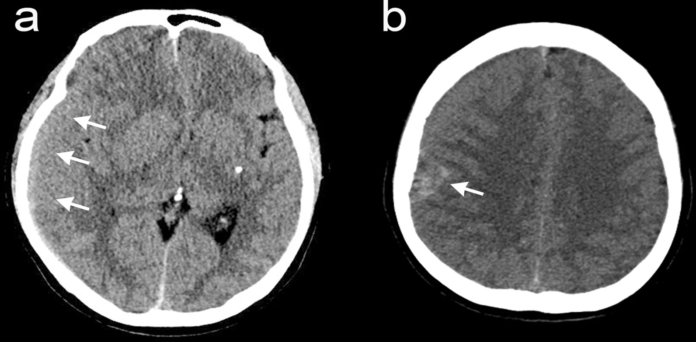 Benign meningioma