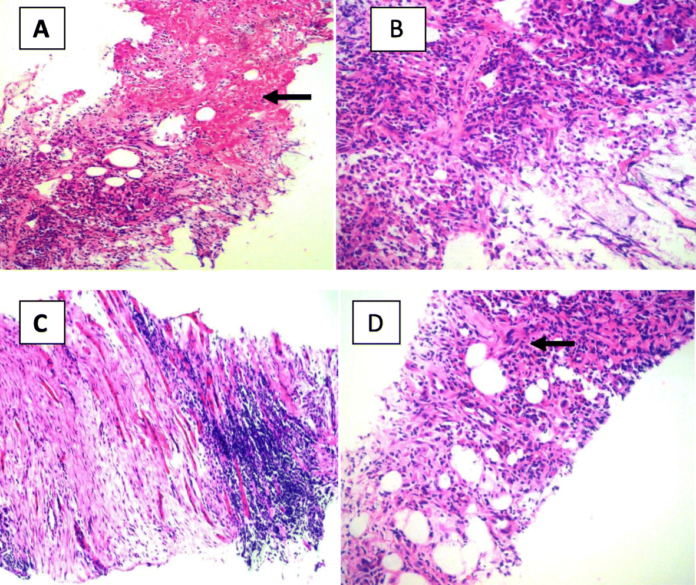 Infective myositis