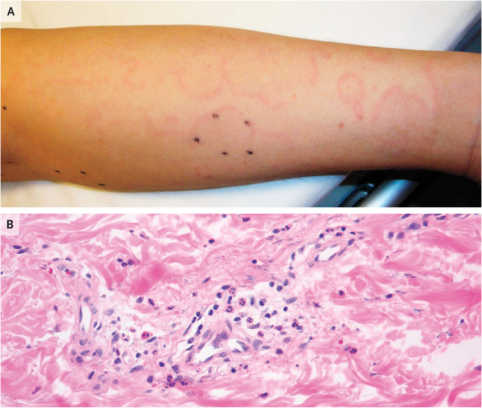 Acute Rheumatic Fever with Erythema Marginatum