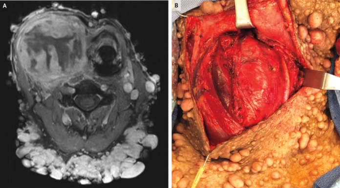 Malignant Peripheral Nerve-Sheath Tumour