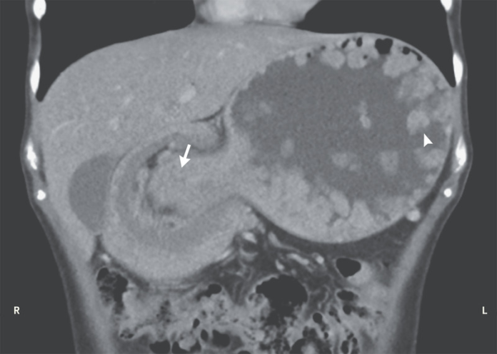 Intussusception in the Peutz–Jeghers Syndrome