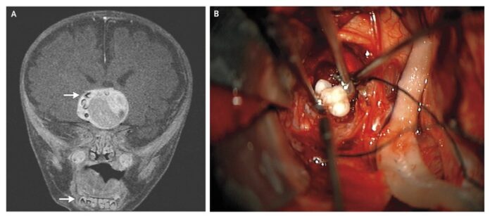 brain tumor