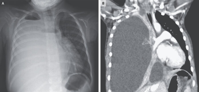 Pneumococcal Empyema