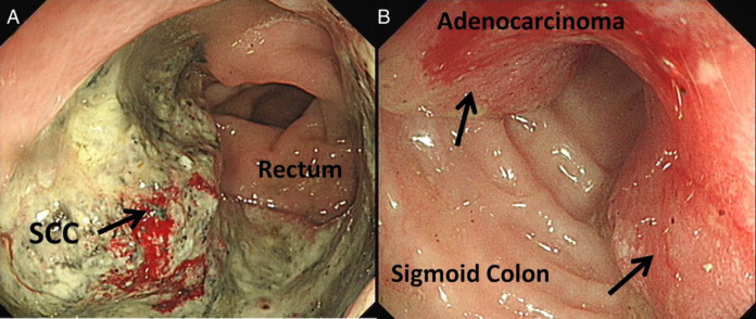 Anal squamous cell carcinoma