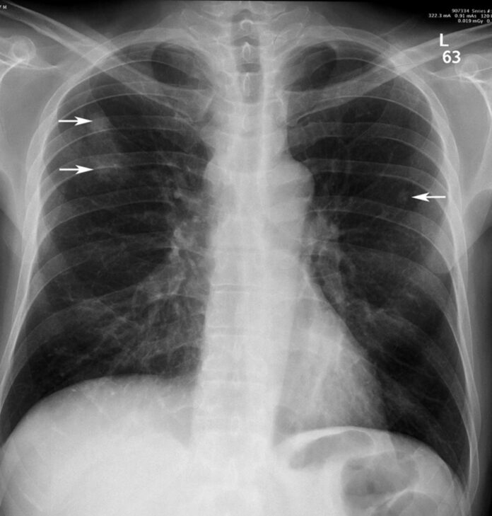 Pulmonary aspergillosis