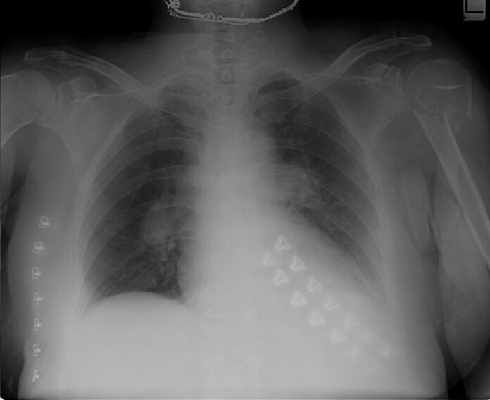 Bilateral pulmonary emboli