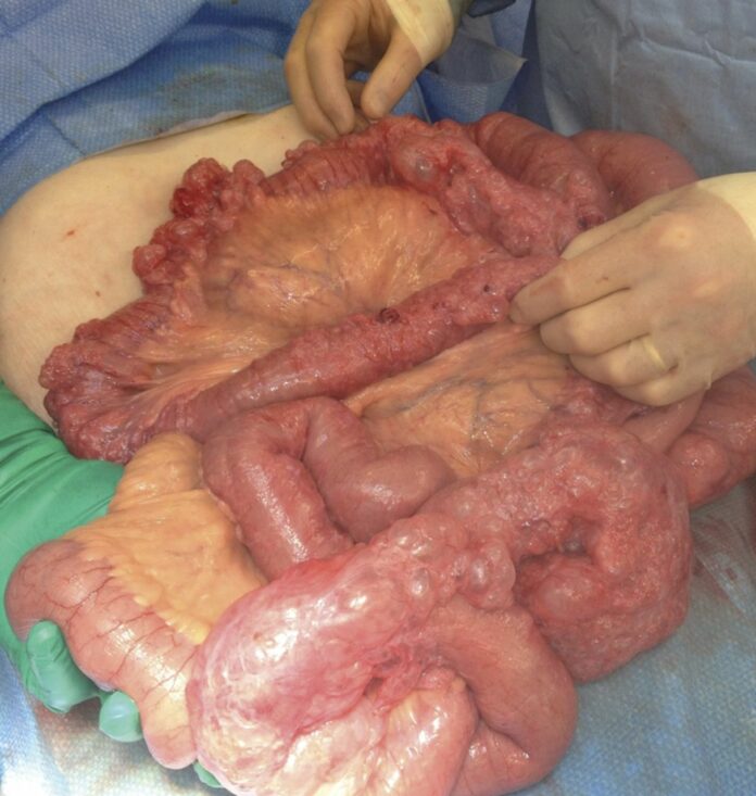 Pneumatosis Intestinalis