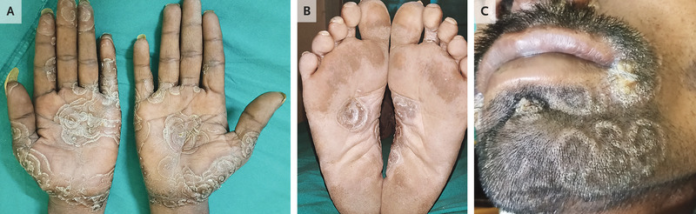 Case of Circinate Syphilitic Lesions