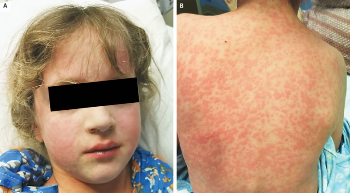 Amoxicillin rash in 7-year-old with infectious mononucleosis