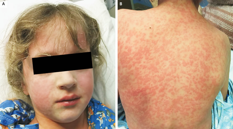 Amoxicillin Rash In 7 year old With Infectious Mononucleosis