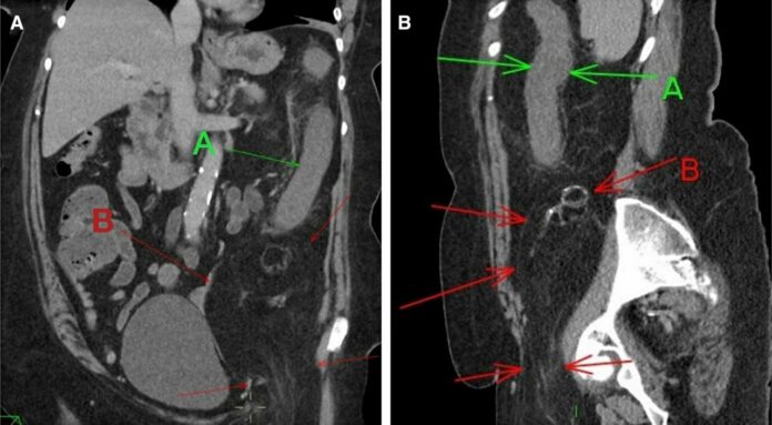 Retroperitoneal liposarcoma