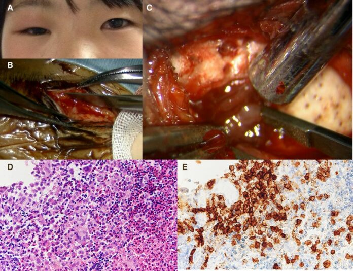 Langerhans cell histocytosis