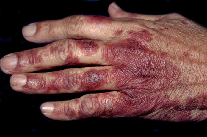 Chemotherapy-Induced Acral Erythema