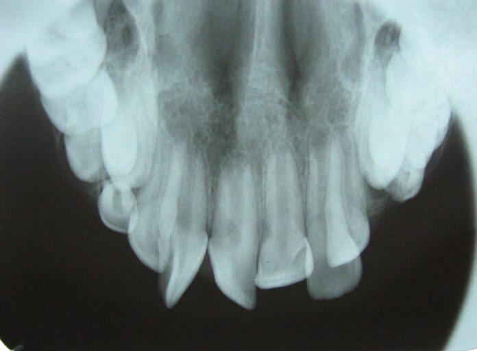 Supernumerary teeth