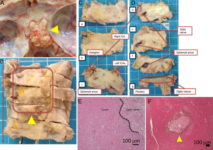 intracranial fibromatosis