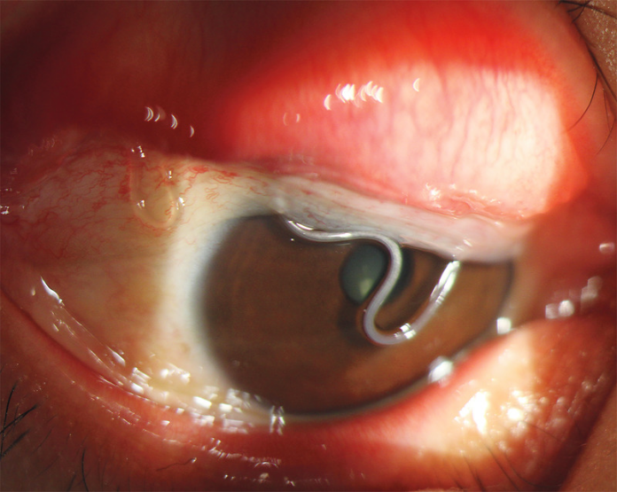 Ocular Thelaziasis