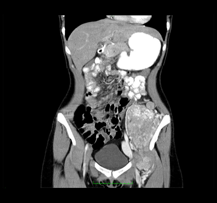 Retroperitoneal alveolar soft-part sarcoma