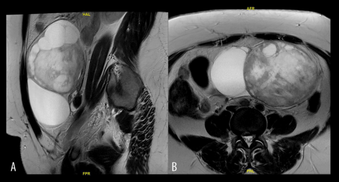 Microcystic tumour of the ovary