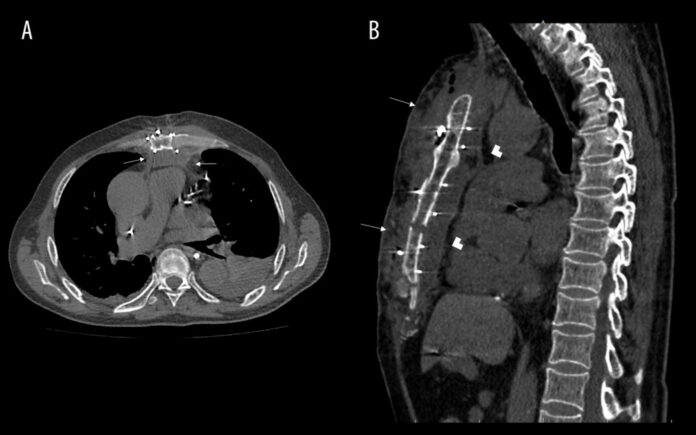 Aspergillus Mediastinitis