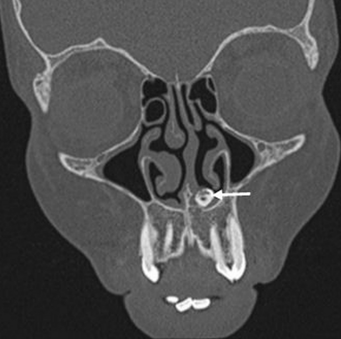 Rare Case Of An Ectopic Tooth In a Nose