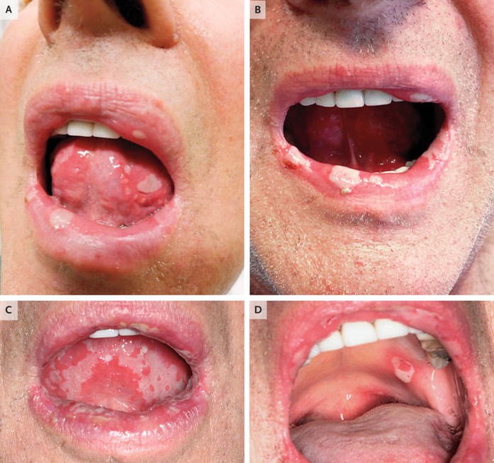 Mouth ulcers