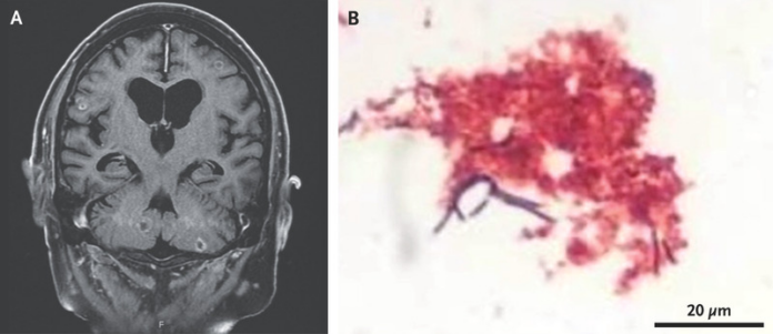 Nocardia brain abscess