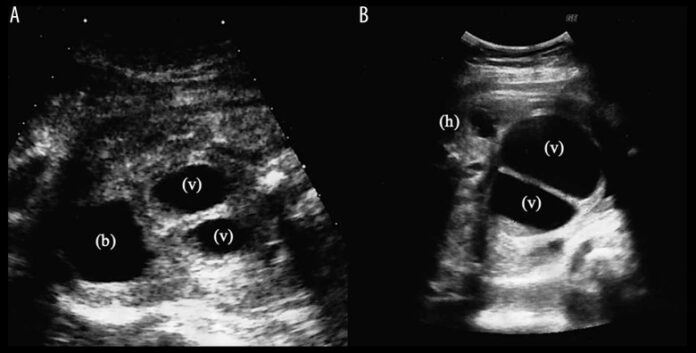 persistent cloaca