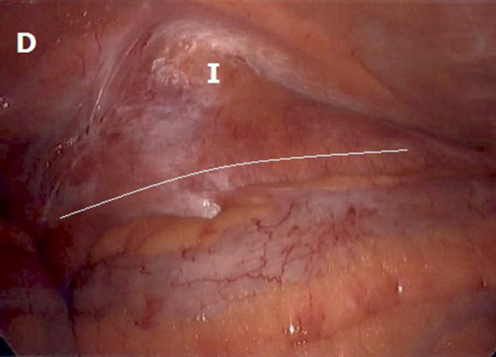 Ureteroinguinal hernia