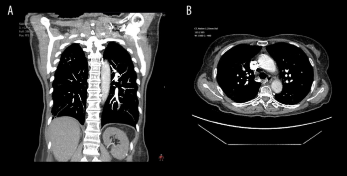 Chronic Thromboembolic Pulmonary Hypertension