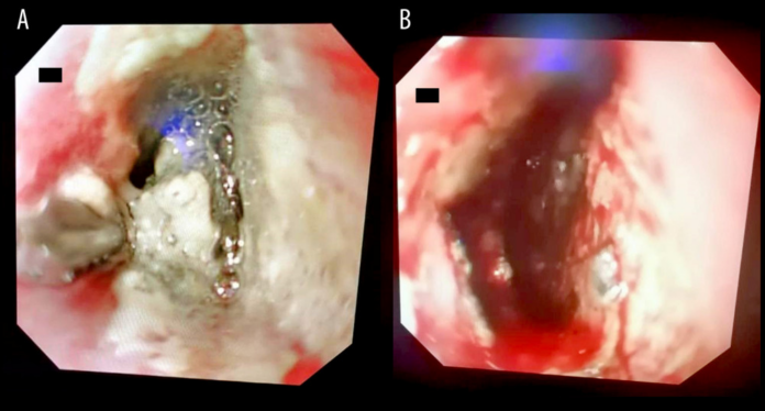 Aortoesophageal Fistula