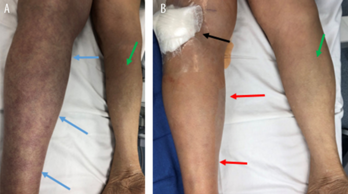 May-Thurner Syndrome