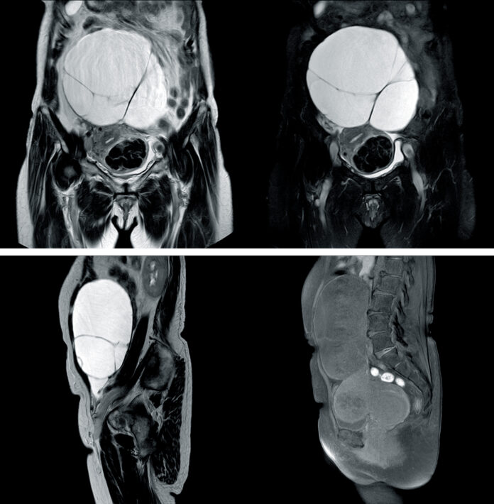 Imaging showing cystic abdominal mass