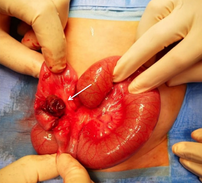 Neonatal intussusception