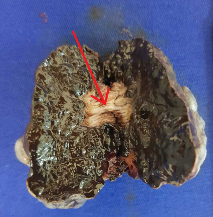 Anorectal mucosal melanoma