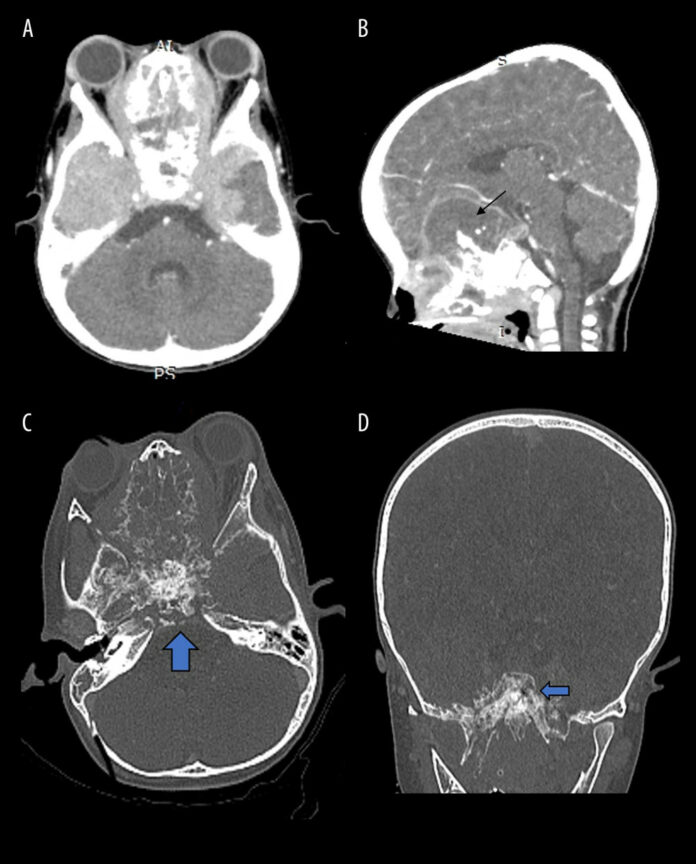 Ewing Sarcoma