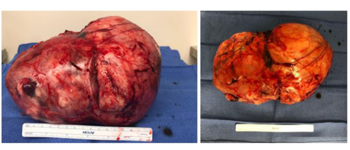 Solitary fibrous tumour